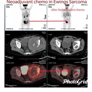 Neoadjuvant Chemo in Ewings Sarcoma by Dr. Rahul Kulkarni