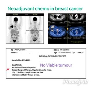 Neoadjuvant chemo in breast cancer by Dr. Rahul Kulkarni