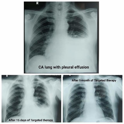 Targeted Therapy in Lung Cancer|OncoWin Clinic|Aundh,Pune