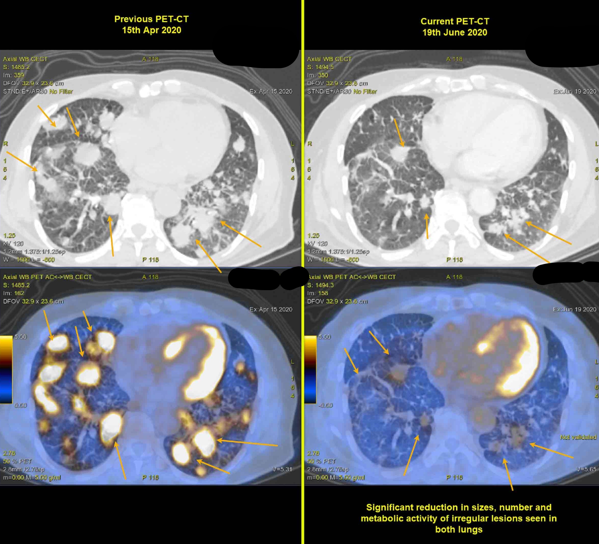 Chemotherapy In Stage 4 Lung Cancer| Dr Rahul Kulkarni| Oncowin Cancer  Clinic